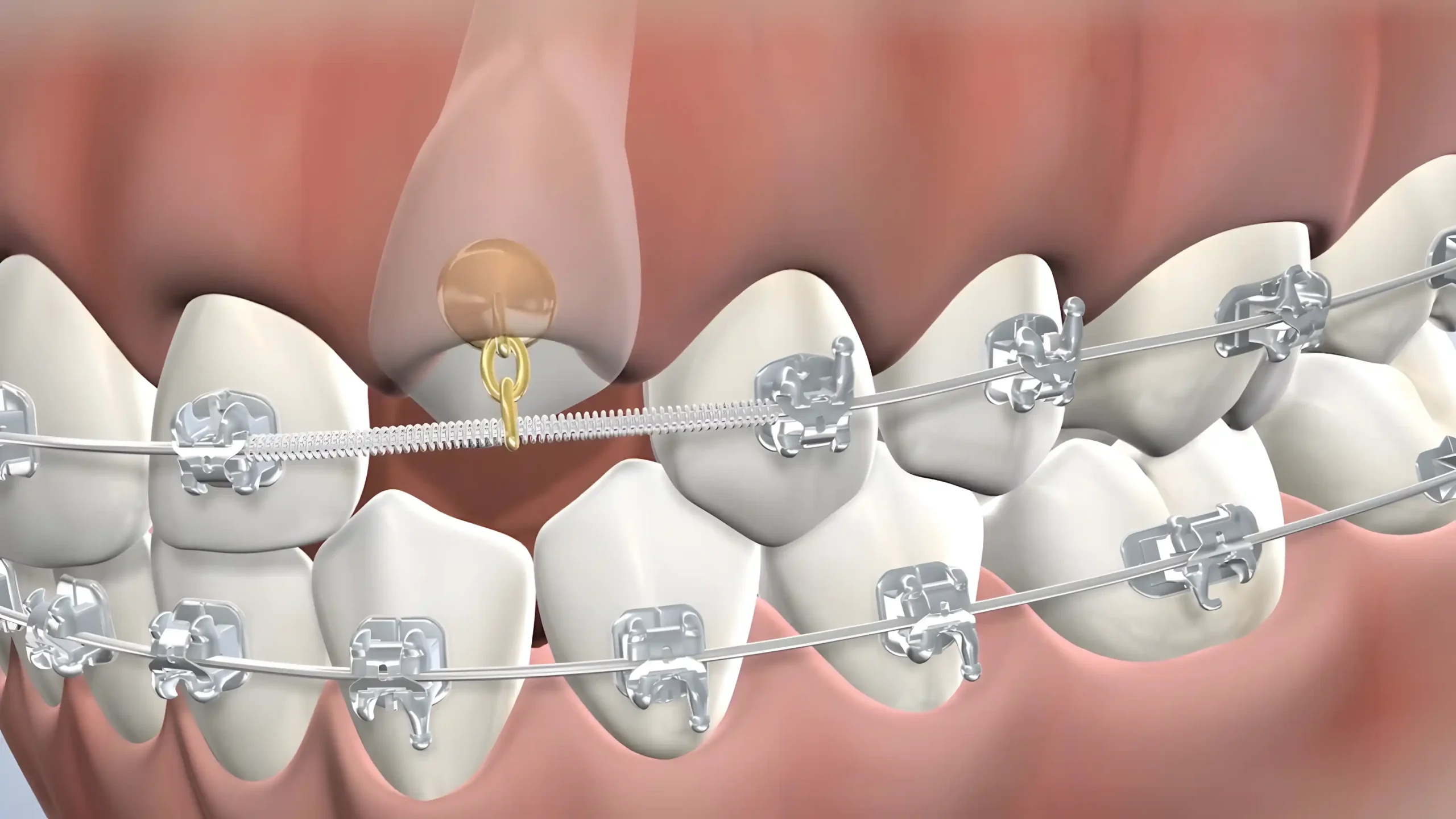 Impacted Canines banner